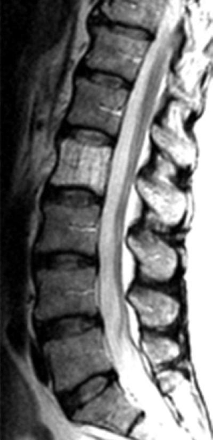 What is vertebral hemangiomas?
