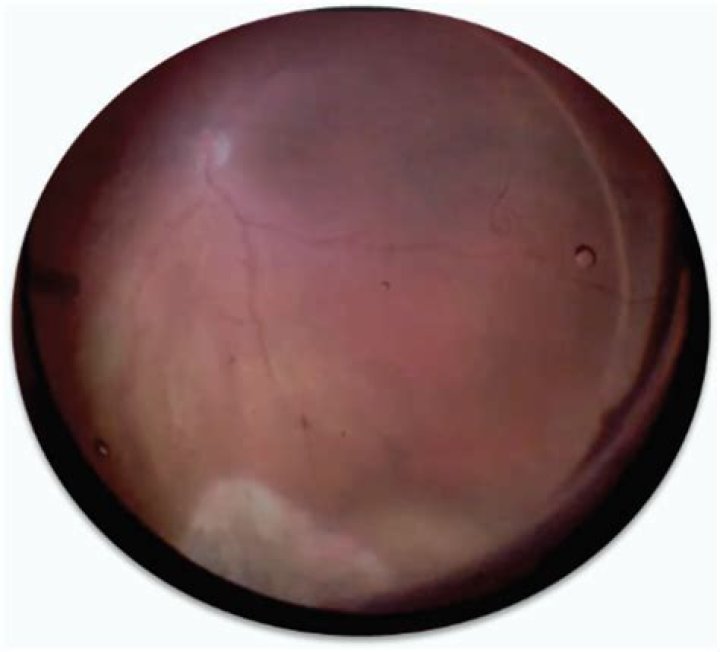 What is vitreous opacities?