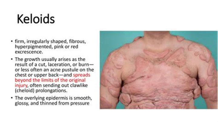 What keloids look like?
