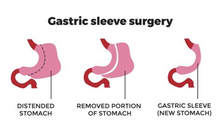 What qualifies you for gastric sleeve?