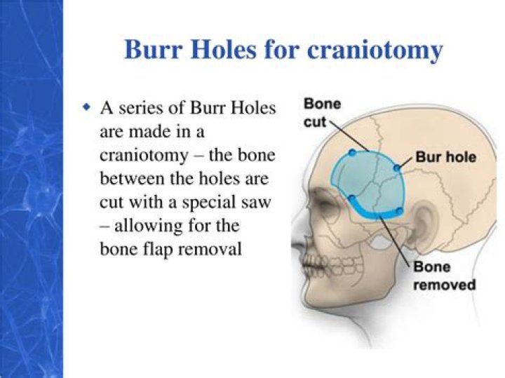 Whats a burr hole?