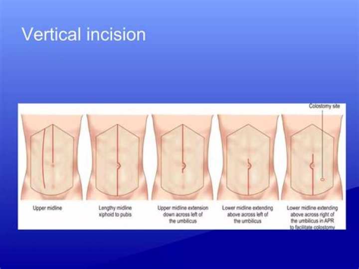 Whats a flank incision?