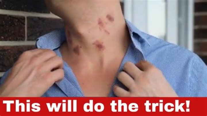 Whats a hicky on your neck?