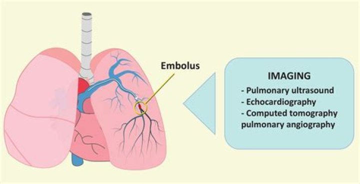 Whats a saddle embolus?