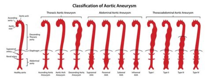Whats a thoracic aneurysm?