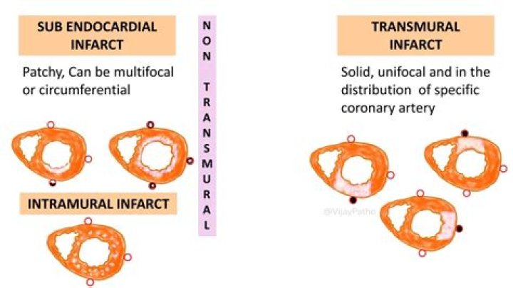 Whats a transmural infarction?