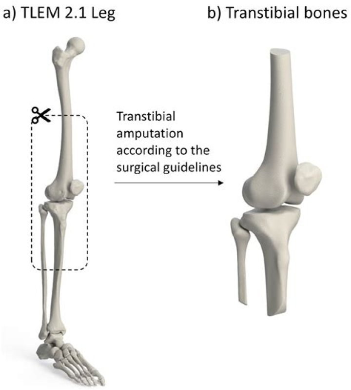 Whats a transtibial amputation?