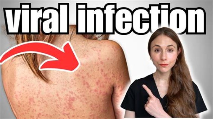 Whats a viral uri?