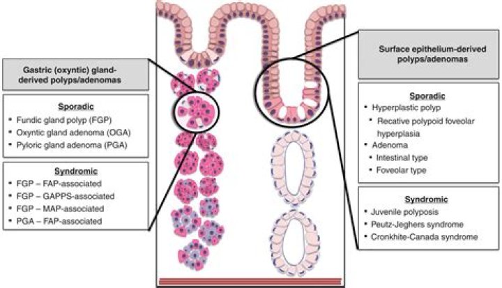 Whats fundic gland polyp?