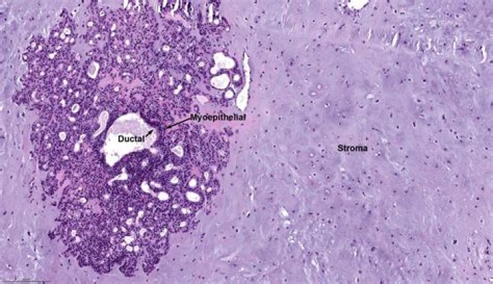 Whats the plural of adenoma?