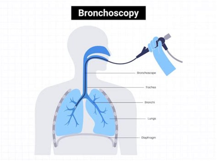 When a bronchoscopy is performed under fluoroscopic guidance?