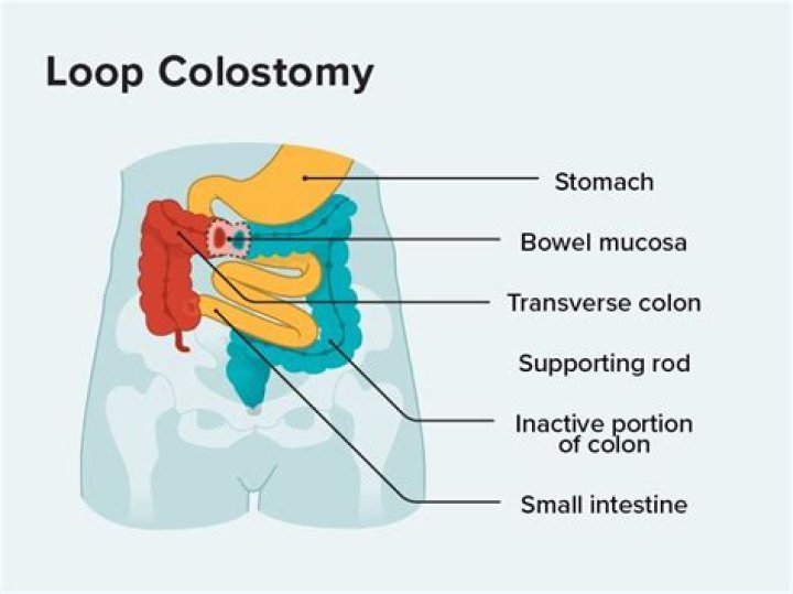 When can ileostomy be reversed?