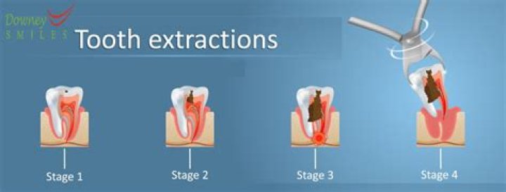 When does a tooth need to be extracted?