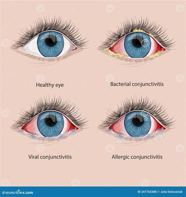 When does conjunctivitis stop being contagious?