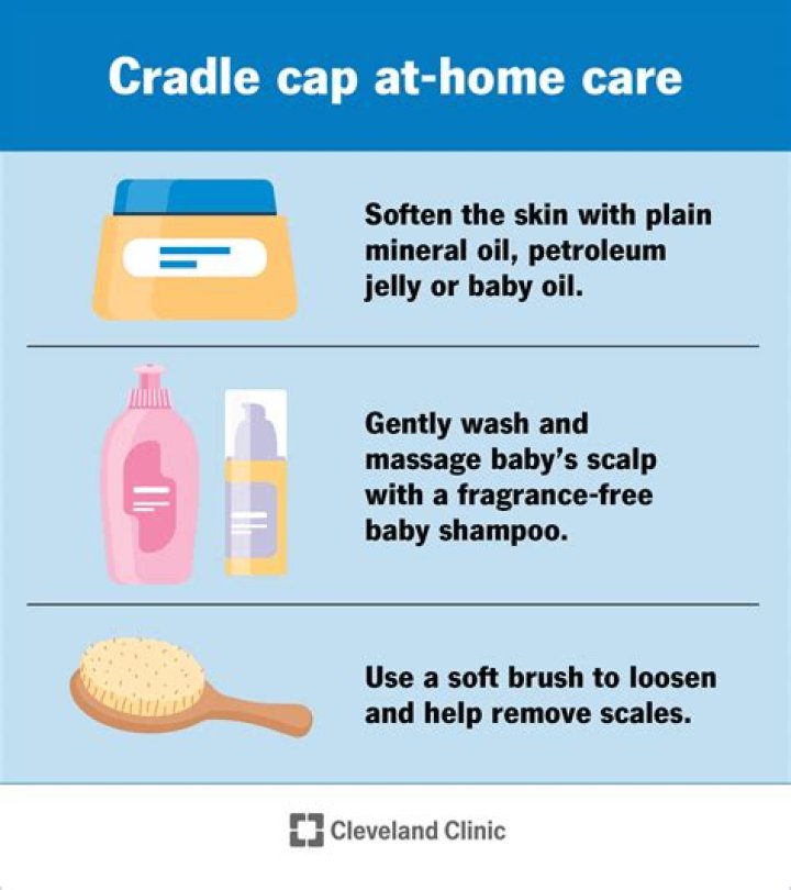 When does cradle cap start?