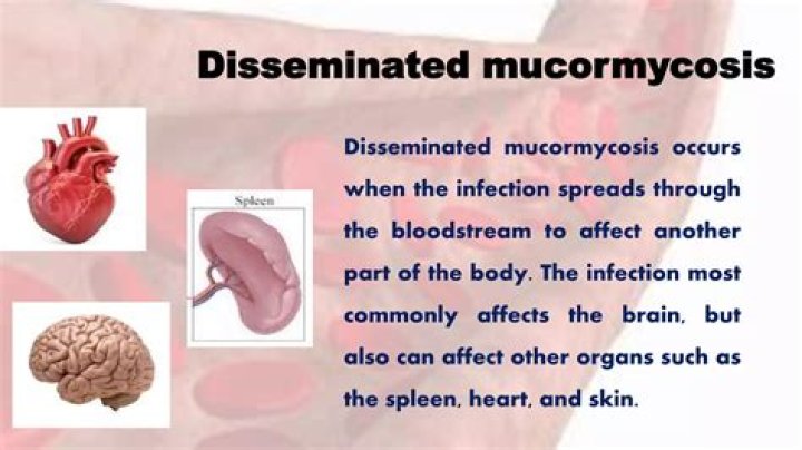 When does mucormycosis occurs?