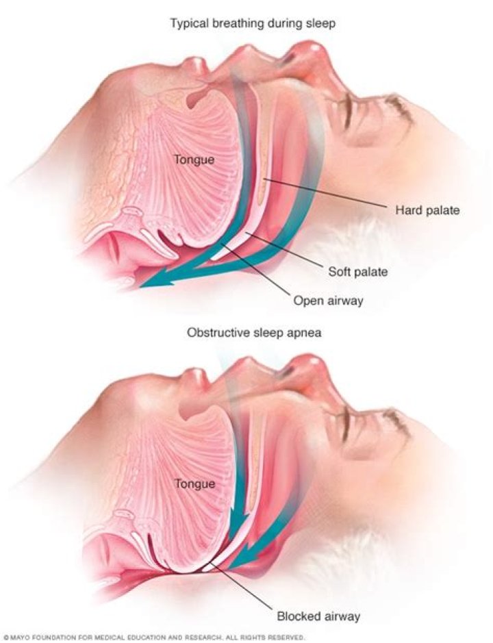 When does obstructive sleep apnea occur?