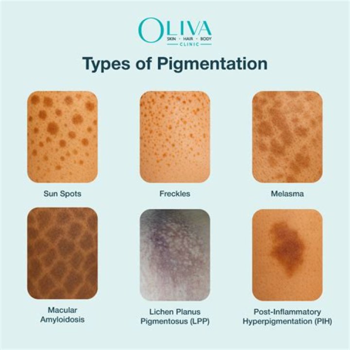 When does pigmentation occur?