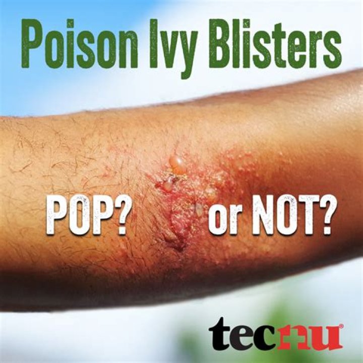 When poison ivy blisters pop?