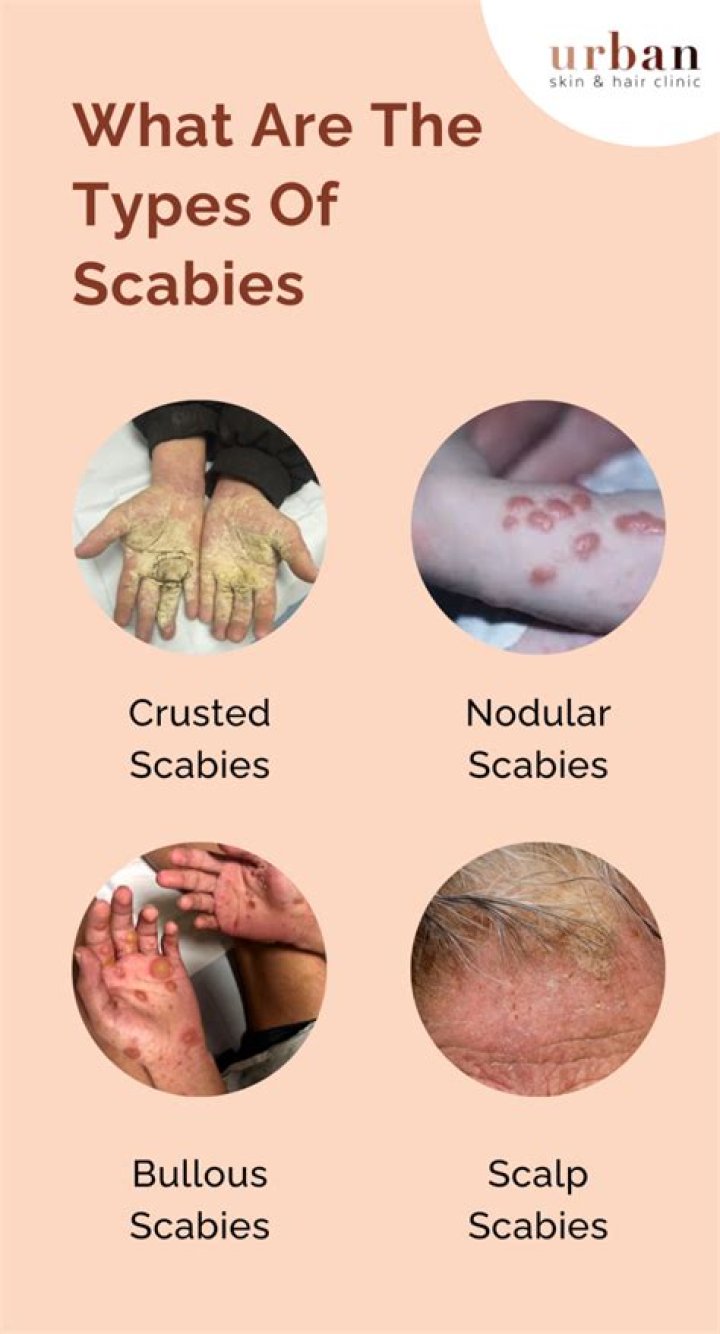 When scabies are healing?