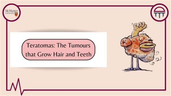 When should a teratoma be removed?