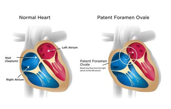 When should foramen ovale close?