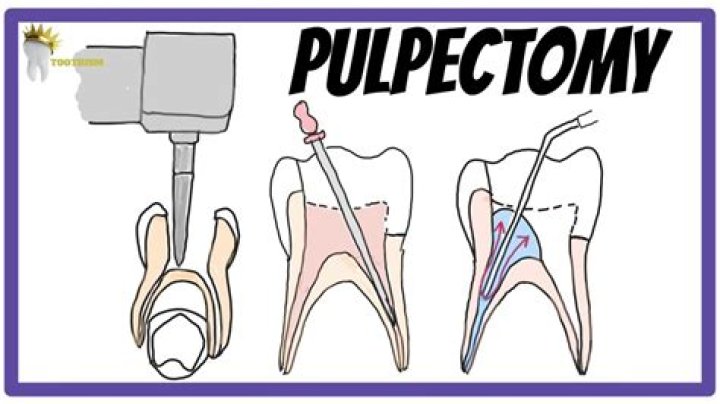 When to do pulpectomy?