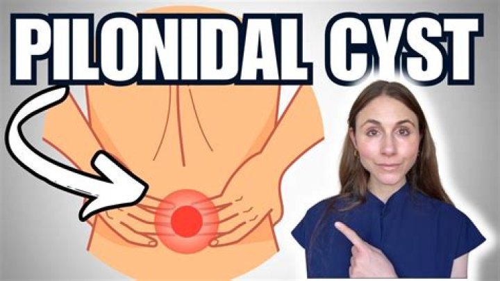 When to go to hospital for pilonidal cyst?