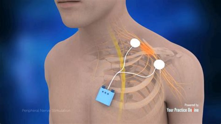 When to use root stimulator?