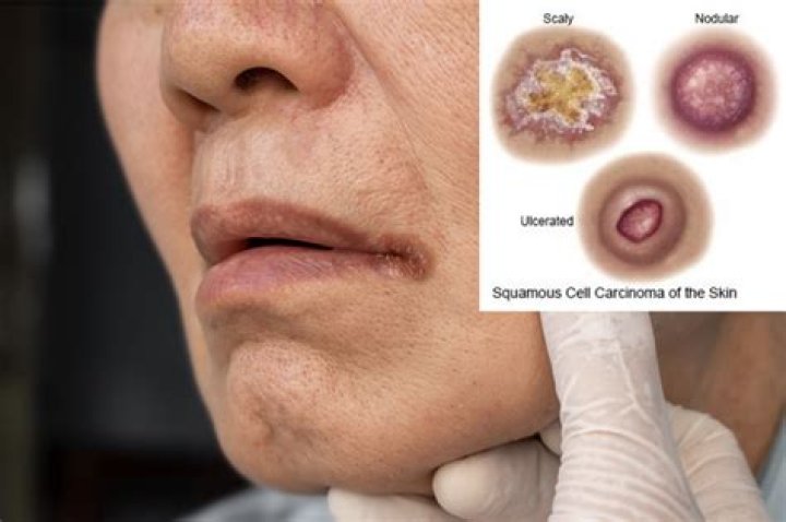 When was squamous cell carcinoma discovered?