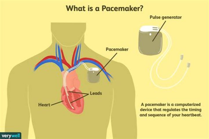 When was the pacemaker invented?