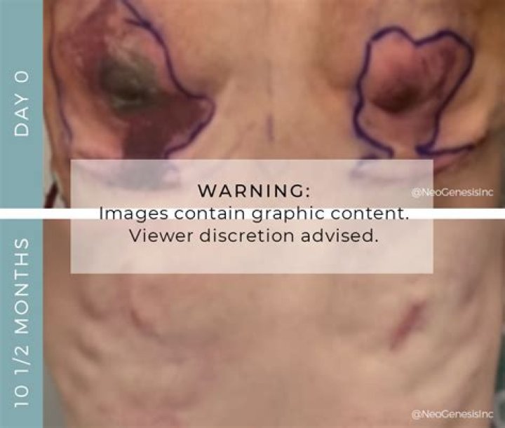 When were mastectomies first performed?