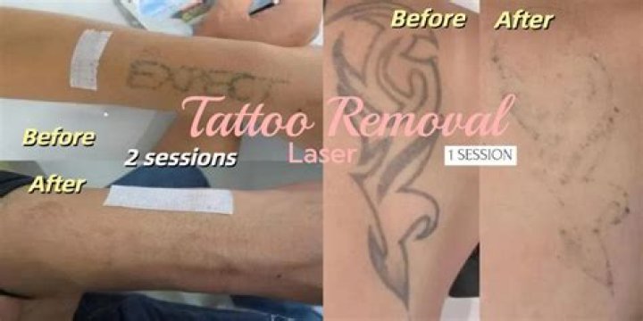 When will soliton tattoo removal be available?