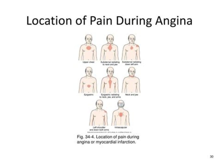 Where angina pain is located?