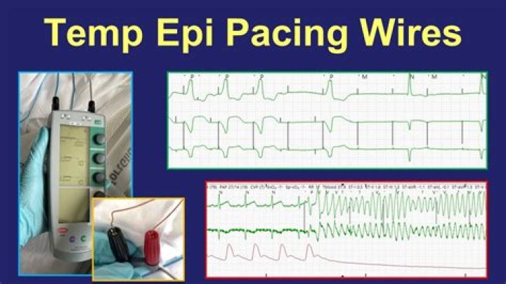 Where are pacer wires placed?