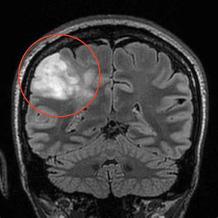 Where can oligodendroglioma be found?