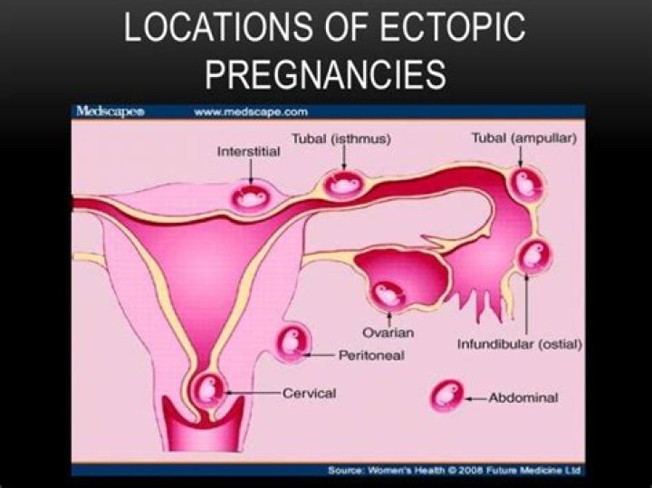 Where do ectopic pregnancies occur?