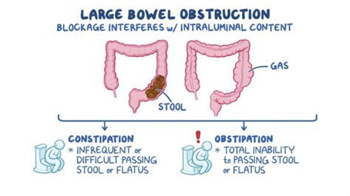 Where do intestinal blockages occur?