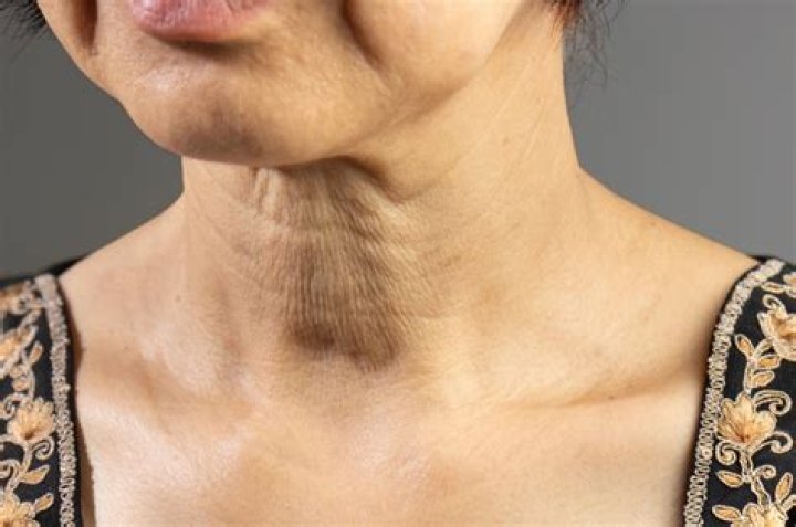 Where do neck creases come from?