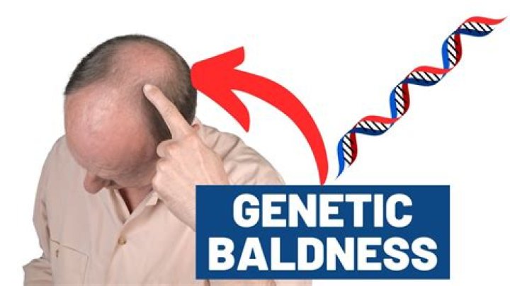 Where does baldness come from genetically?