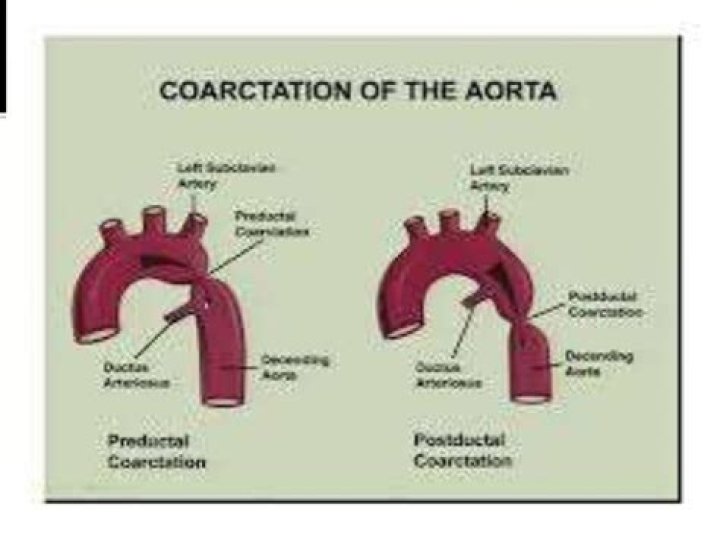Where does coarctation of the aorta occur?