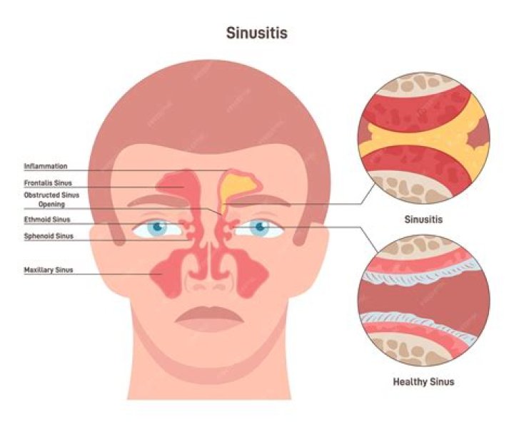 Where does sinus congestion come from?