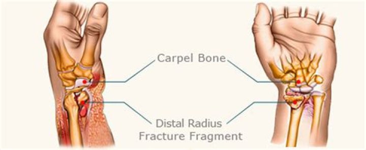 Where is distal radius fracture?