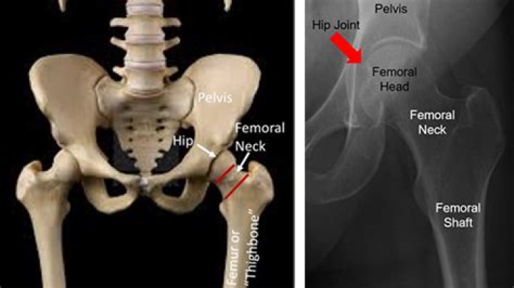 Where is femoral neck?