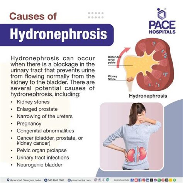 Where is hydronephrosis pain?