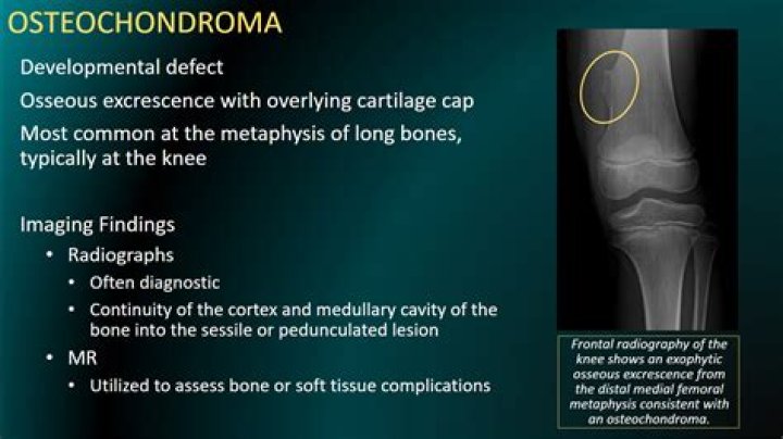 Where is osteochondromas located?