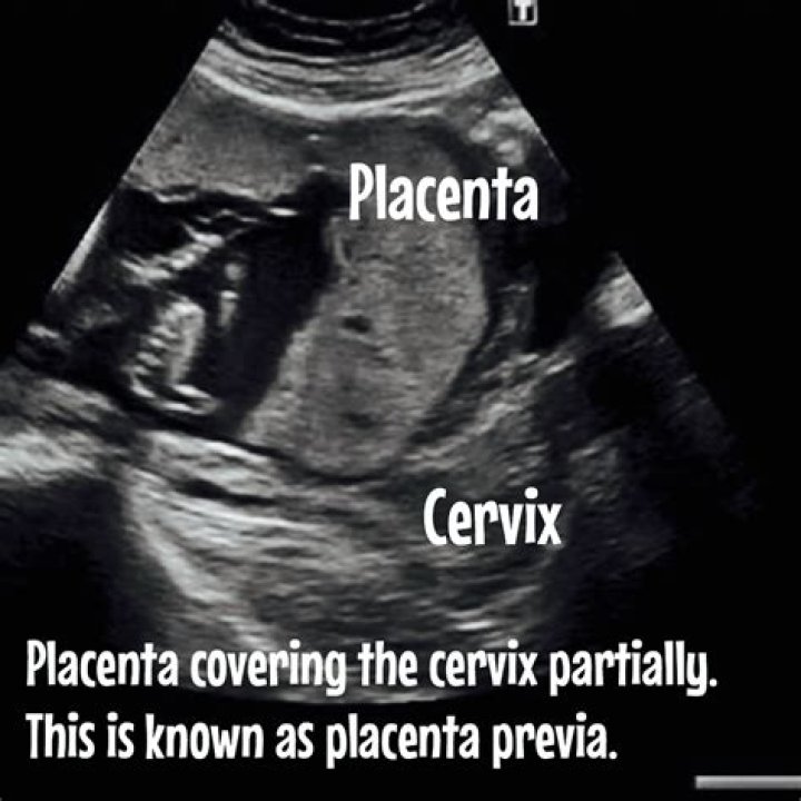 Where is placenta on ultrasound?