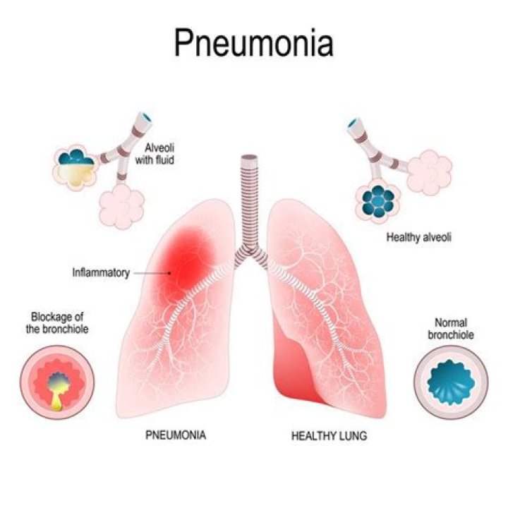 Where is pneumonia found?