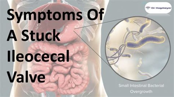 Where is the ileocecal valve?