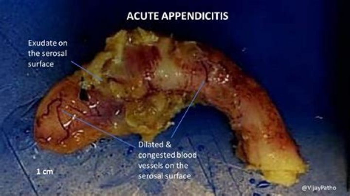 Where is the serositis located?